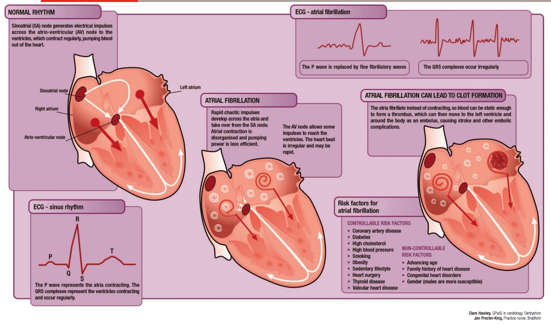 Back to Basics: What goes wrong in atrial fibrillation? - Issues and ...