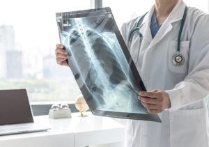 Doctor reviewing a Chronic obstructive pulmonary disease patient's chest x-ray
