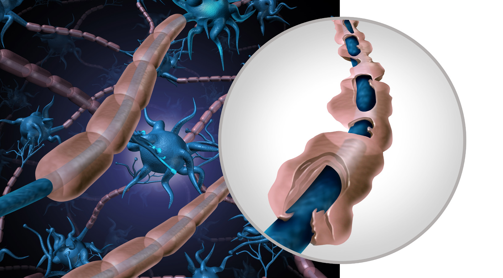 Multiple sclerosis in primary care – diagnosis and early treatment - Issues and Answers